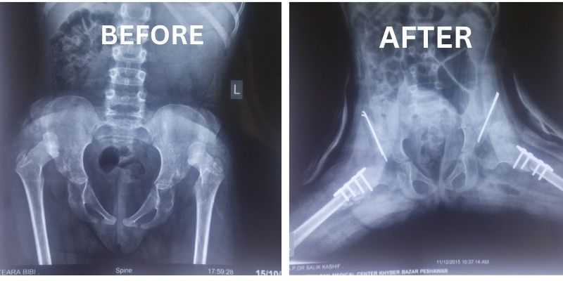 Hip Dislocation